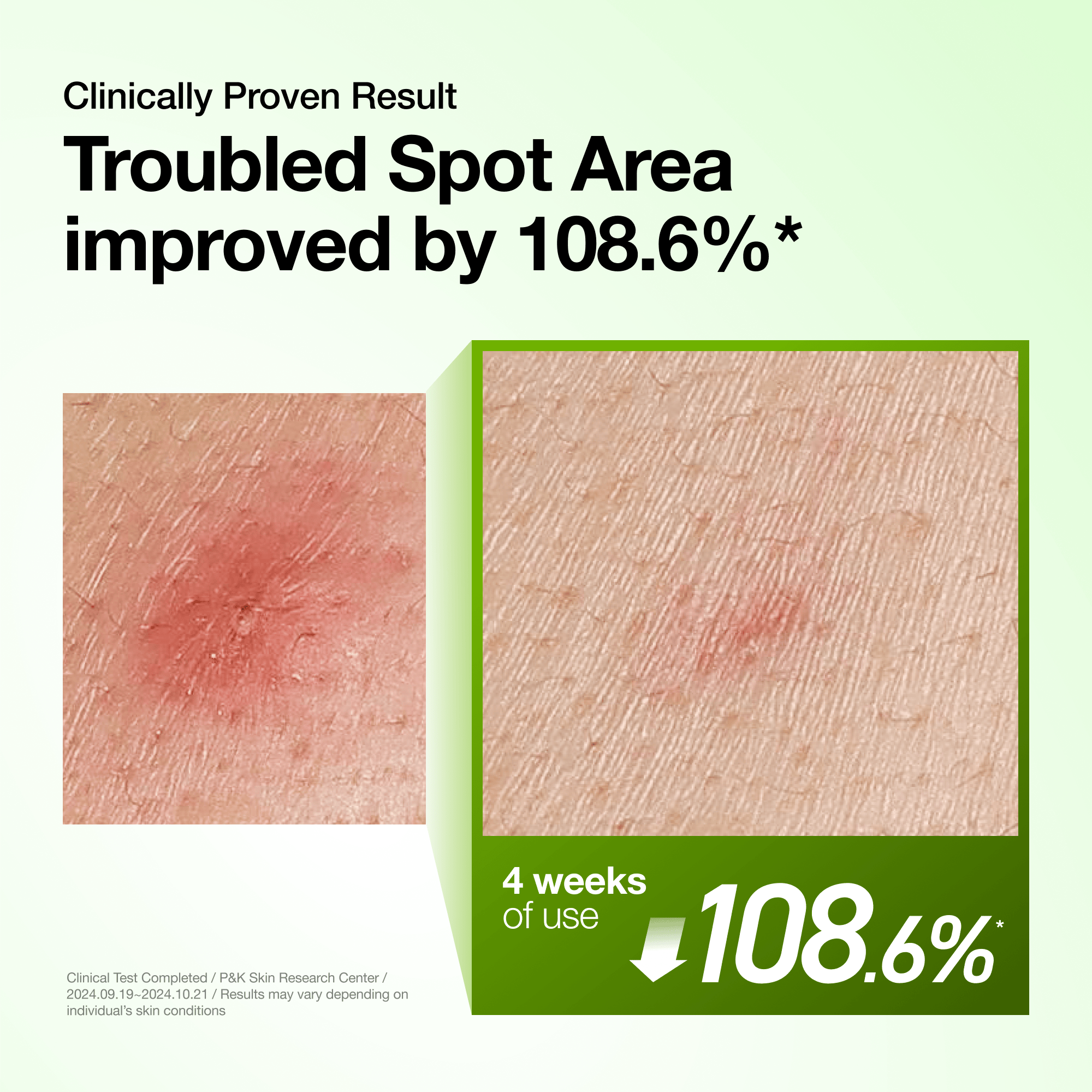 Anua 10% Azelaic Acid Serum With Hyaluronic Acid